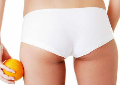 Cellulite removal (photos not modified) from Dana Clinic, Prague 9, Kbely