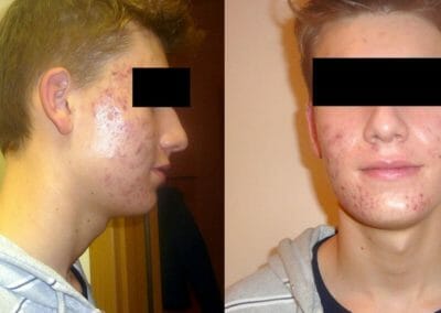 Dermatologists recommend oxygen mesotherapy for the treatment of acne and oily skin, client after 12 treatments, Dana Clinic, Prague 9,