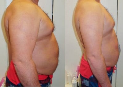 Bezbolestná liposukce, hubnutí kombinací (kryolipolýza, lipolaser, Slim-up atd.) a zpevnění, 13 cm během 6 týdnů, Dana Clinic, Praha 9