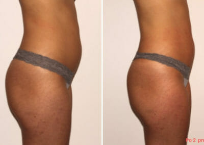 Painless liposuction, slimming of hips, buttocks and thighs after two procedures, 2 cm loss, Dana Clinic, Prague 9, Try it and see the result right away.