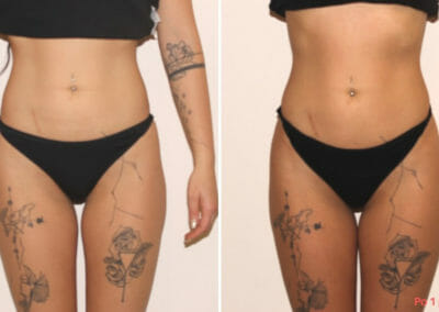 Painless liposuction, slimming of the hips and shaping the waist after one procedure, 2 cm loss, Dana Clinic, Prague 9, Try it and see the result right away.