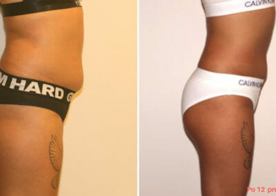 Non-invasive liposuction without surgery, client 10 cm loss after 12 courses. Book now in Prague 9