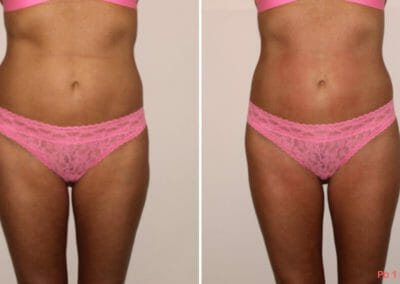 Painless liposuction, slimming of the abdomen, hips, thighs after one procedure, 2 cm loss, Dana Clinic, Prague 9, Try it and see the result right away.