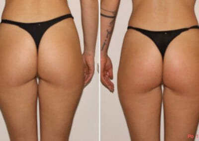 Painless removal of cellulite and fat on thighs and buttocks, after one procedure, Dana Clinic, Prague 9, fast and effective.