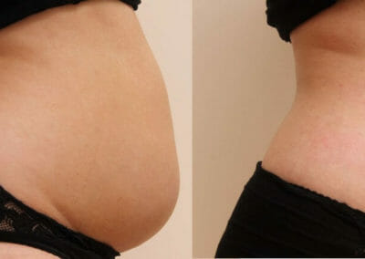 Bezbolestná liposukce, hubnutí po porodu, kombinací (kryolipolýza, lipolaser, Slim-up atd.) a zpevnění, 13 cm během 6 týdnů, Dana Clinic, Praha 9