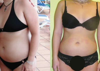 Painless liposuction, weight loss after 10 treatments, loss of 12 cm, Dana Clinic, Prague 9. Try and see the result right away.
