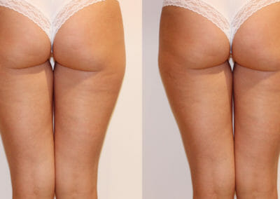 Painless liposuction and alleviation of cellulite on thighs, after 1 procedure, Dana Clinic, Prague 9, fast and effective