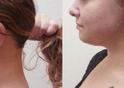 Painless liposuction and chin after 1 treatment. Dana Clinic, Prague 9, fast and efficient
