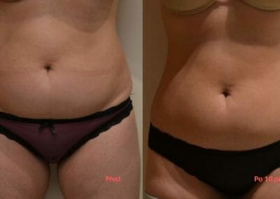 Painless liposuction and abdominal firming, after 10 treatments, 10 cm loss, Dana Clinic, Prague 9, Try it now and see the result right away