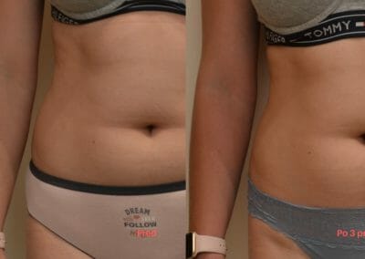 Painless liposuction and abdominal firming, after 3 treatments, 4 cm loss, Dana Clinic, Prague 9, Try it and see the result right away.
