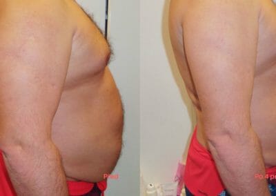 Painless liposuction and abdominal firming, after 4 treatments, 7 cm loss, Dana Clinic, Prague 9, Try it now and see the result right away.