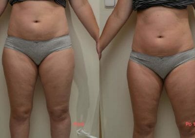 Painless liposuction and strengthening of the back and abdomen, after 1 procedure, loss of 3 cm, Dana Clinic, Prague 9, Try it now and see the result right away