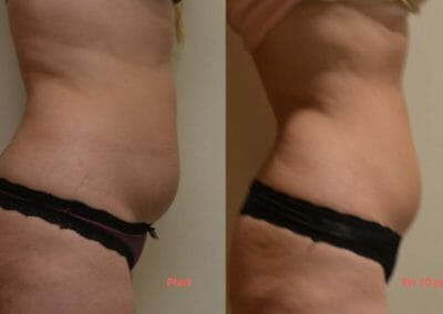 Painless liposuction and body firming, after 10 procedures, 10 cm loss, Dana Clinic, Prague 9, Try it now and see the result right away