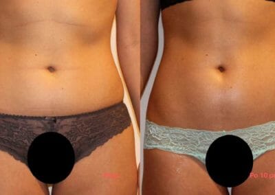 Painless liposuction and body firming, after 10 treatments, 8 cm loss, Dana Clinic, Prague 9, Try it now and see the result right away