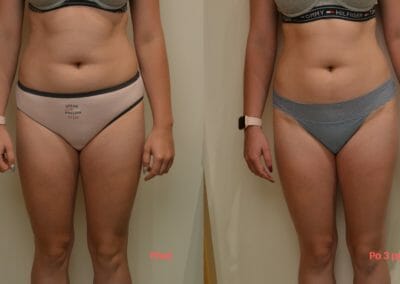 Painless liposuction and body firming, after 3 treatments, 4 cm loss, Dana Clinic, Prague 9, Try it and see the result right away.