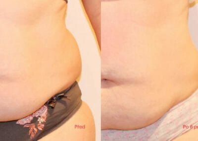 Painless liposuction and body firming, after 6 treatments, 6 cm loss, Dana Clinic, Prague 9, Try it now and see the result right away