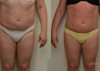 Painless liposuction and body firming, after 6 treatments, 7 cm loss, Dana Clinic, Prague 9, Try it now and see the result right away