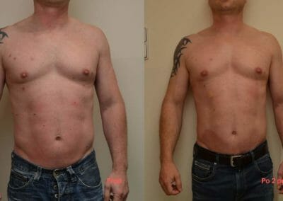 Painless liposuction and body firming after two treatments, 4 cm loss, Dana Clinic, Prague 9, Try it now and see the result right away