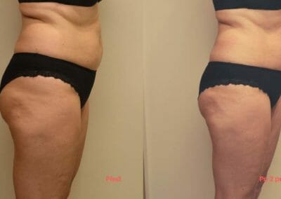 Painless liposuction and body firming after two treatments, 4 cm loss, Dana Clinic, Prague 9, Try it out and see the result right away.