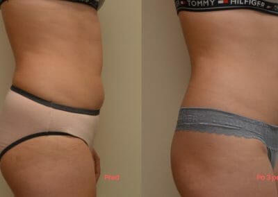 Painless liposuction and firming, back and abdomen, after 3 treatments, 4 cm loss, Dana Clinic, Prague 9, Try it and see the result right away.