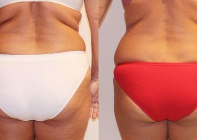 Painless liposuction, weight loss of the back and buttocks after eight treatments, loss of 9 cm, Dana Clinic, Prague 9, Try it and see the result