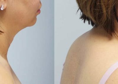 Painless liposuction and rejuvenation of the chin after 1 treatment. Dana Clinic, Prague 9, quickly and effectively