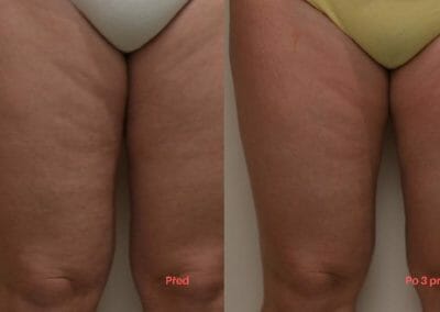 Bezbolestná liposukce, zpevnění nohou, odstranění celulitidy, po 3 procedúrách, Dana Clinic, Praha 9