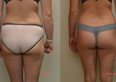 Lipolaser liposuction of more areas simultaneously, non-invasive liposuction without surgery, client 7 cm loss after 5 courses Praha 9.