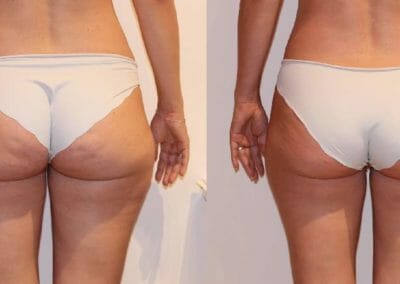 Slim up cellulite removal in Prague, after 1 procedure, Dana Clinic, Prague 9, quick and effective.