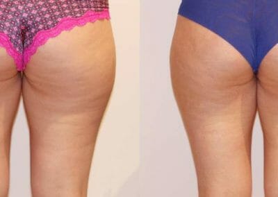 Slim-up cellulite removal after 1 treatments, Dana Clinic, Prague 9, Try it.