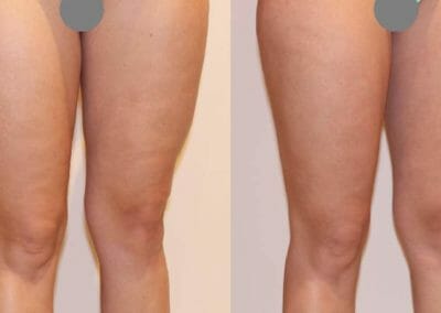 Painless liposuction and alleviation of cellulite on thighs, after 1 procedure, Dana Clinic, Prague 9, fast and effective.