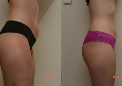 Painless liposuction, abdomen and hips after 4 treatments, 3 cm loss, Dana Clinic, Prague 9, Try it now and see the result right away.