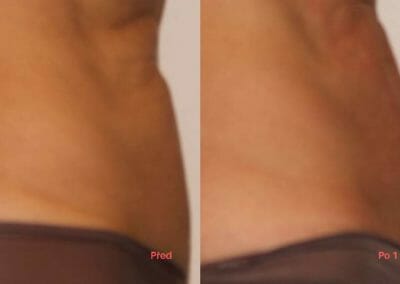 Painless liposuction and abdominal firming after one procedure, 3 cm loss, Dana Clinic, Prague 9,