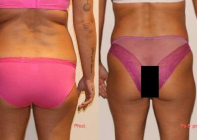 Painless liposuction, weight loss of the back and buttocks after eight treatments, loss of 9 cm, Dana Clinic, Prague 9, Try it.