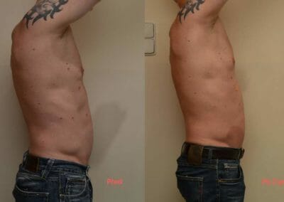 Painless body liposuction after two procedures, 3 cm loss, Dana Clinic, Prague 9, Try it and see the result right away.