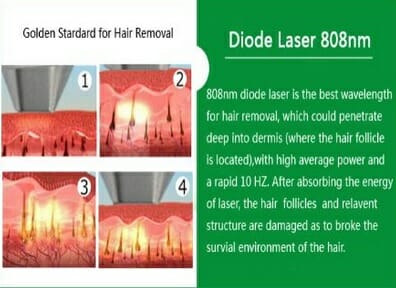 Diodový laser 808 na odstranění nežádoucích chloupků je rychlý a účinný, Dana Clinic, Praha 9