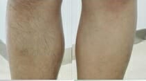 Diode laser hair removal after 4 treatments, Prague 9, try permanent epitation.