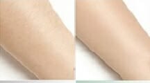 Diode laser hair removal after 4 treatments, Prague 9,