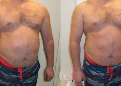Painless liposuction and abdominal firming, after 4 treatments, 7 cm loss, Dana Clinic, Prague 9, Try it now and see the result right away.