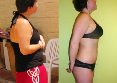 Fettabsaugung ohne OP, Gewichtsverlust nach 10 Behandlungen, Verlust von 12 cm, Dana Clinic, Prag 9. Versuchen Sie, das Ergebnis sofort zu sehen.