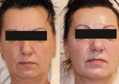 Kyslíková mezoterapie na omlazení obličeje se zmenšením podbradku, 1 kúra, Dana Clinic, Praha 9