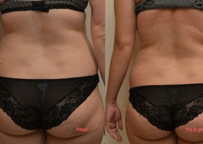 Liposuction of back and hips, buttocks 5 procedures, decrease -6cm, Dana Clinic, Prague 9, try it and see