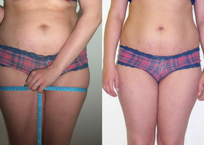 Painless liposuction, weight loss after 8 treatments, 8 cm loss, Dana Clinic, Prague 9. Try it and see the result right away.