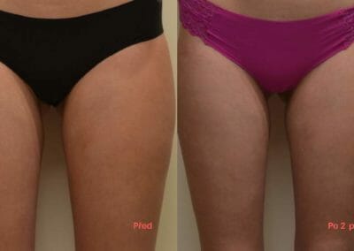 Bezbolestná liposukce a zpevnění (stehna) po dvou procedúrách, úbytek 1,5 cm, Dana Clinic, Praha 9, Vyzkoušejte a výsledek uvidíte hned.