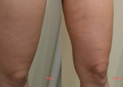 Bezbolestná liposukce, hubnutí nohou po třech procedúrách, úbytek 3 cm, Dana Clinic, Praha 9, Vyzkoušejte a výsledek uvidíte hned.
