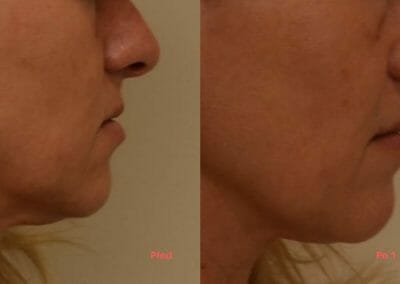 Face rejuvenation by radiofrequency, focusing on face and chin, after 1 treatment, Dana Clinic, Prague 9, Try it and see the result right away.