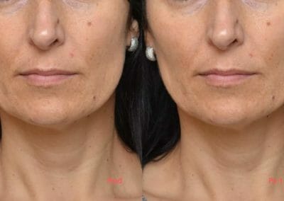 Face rejuvenation by radiofrequency, anti-aging, focusing on the eye area, nosoretic grooves, after 1 treatment, Dana Clinic, Prague 9,