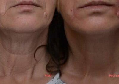 Kyslíková mezoterapie na omlazení obličeje a krku,klientka po 3 kúrách, Dana Clinic, Praha 9, Vyzkoušejte.