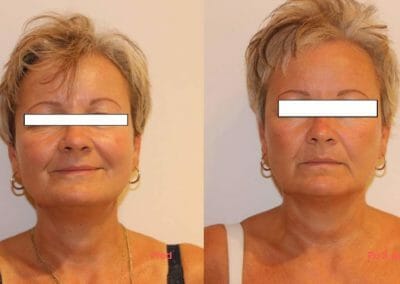 Face rejuvenation by radiofrequency, client after 3 treatments, Dana Clinic, Prague 9, Try it now and see the result right away