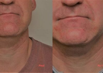 Face rejuvenation by radiofrequency, nasal grooves and facial shrinkage, client after 1 treatment, Dana Clinic, Prague 9, Try it
